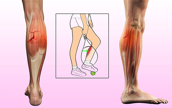 小腿后侧肌肉发力有疼痛感,小腿一发力肌肉就变形疼痛