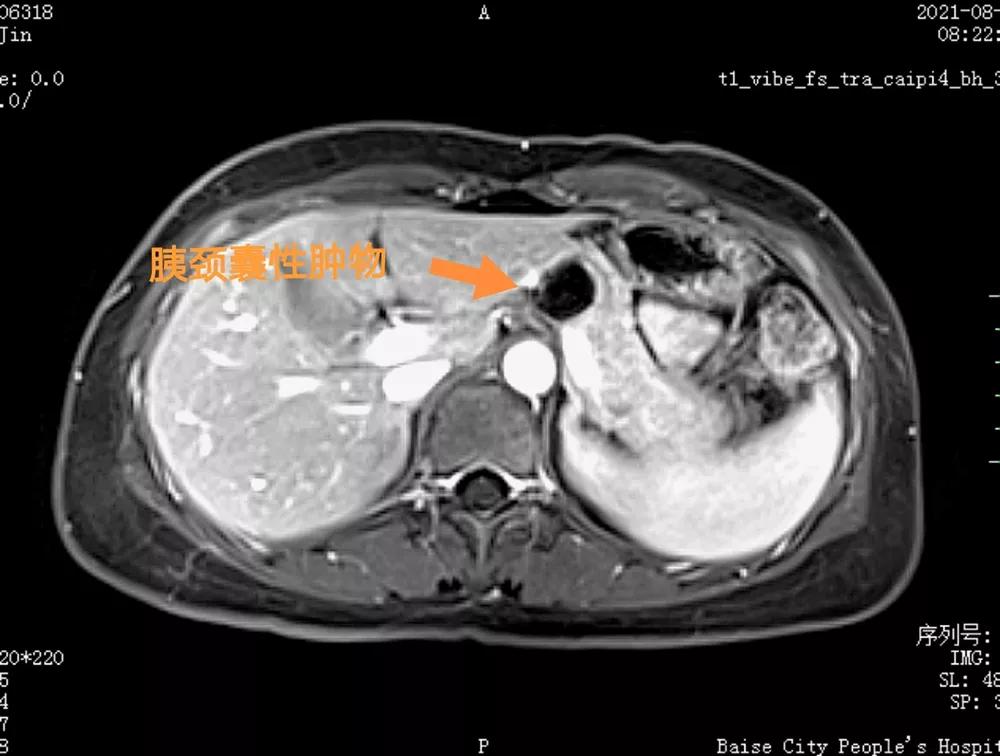 腹腔镜胰腺中段切除术的现状,腹腔镜下胰体尾部切除手术步骤