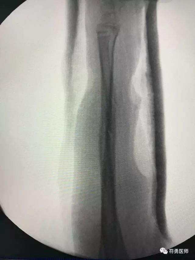 孩子骨折了一定要做打钢针手术吗,儿童摔伤骨折需要手术么