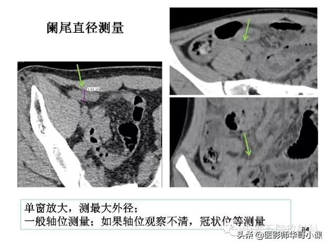 阑尾炎课件,阑尾炎的超声课件