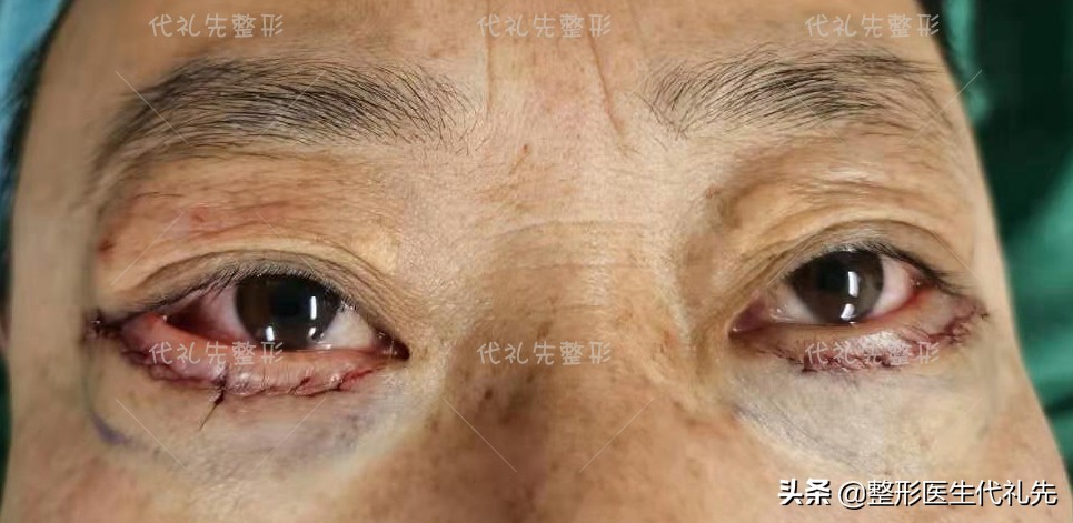 问一下有什么方法快速消除眼袋,关于眼袋的去除方法