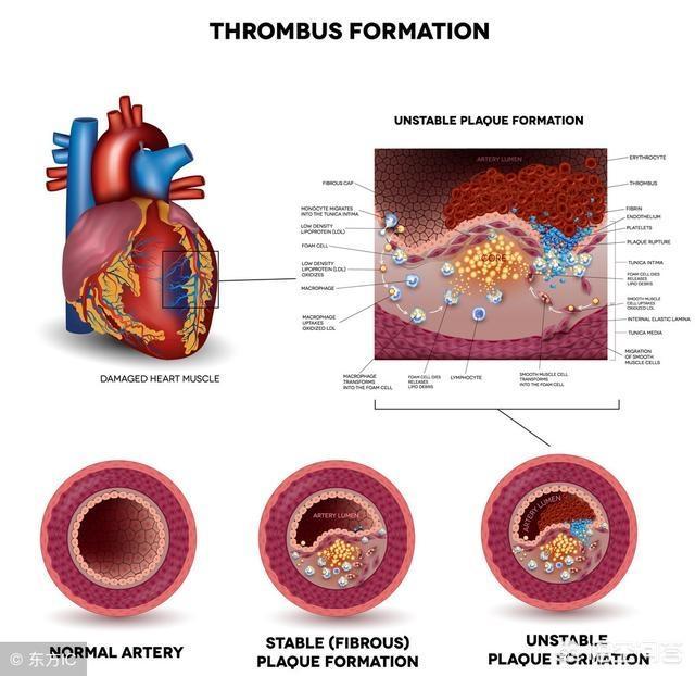 冠状动脉支架为什么又要放球囊,冠状动脉放了支架后可以吃什么