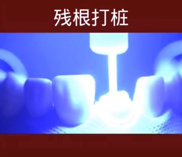 良心牙医不建议拔智齿残根,牙齿残根怎么处理视频