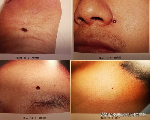 色素痣需要注意哪些事项,色素痣能怎么避免