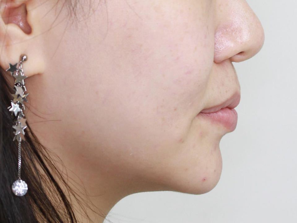 西安张军正畸医生如何,西安牙齿矫正案例