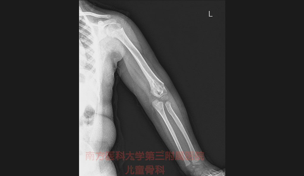 左前臂骨折后的康复训练,手臂外翻或内翻该怎么矫正