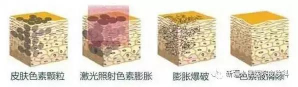 激光祛斑皮肤会变薄吗,燃料激光做了以后皮肤会变薄嘛