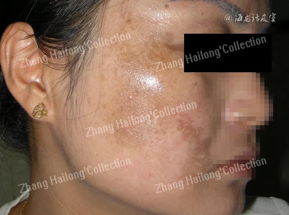 褐斑治疗,褐斑怎么办