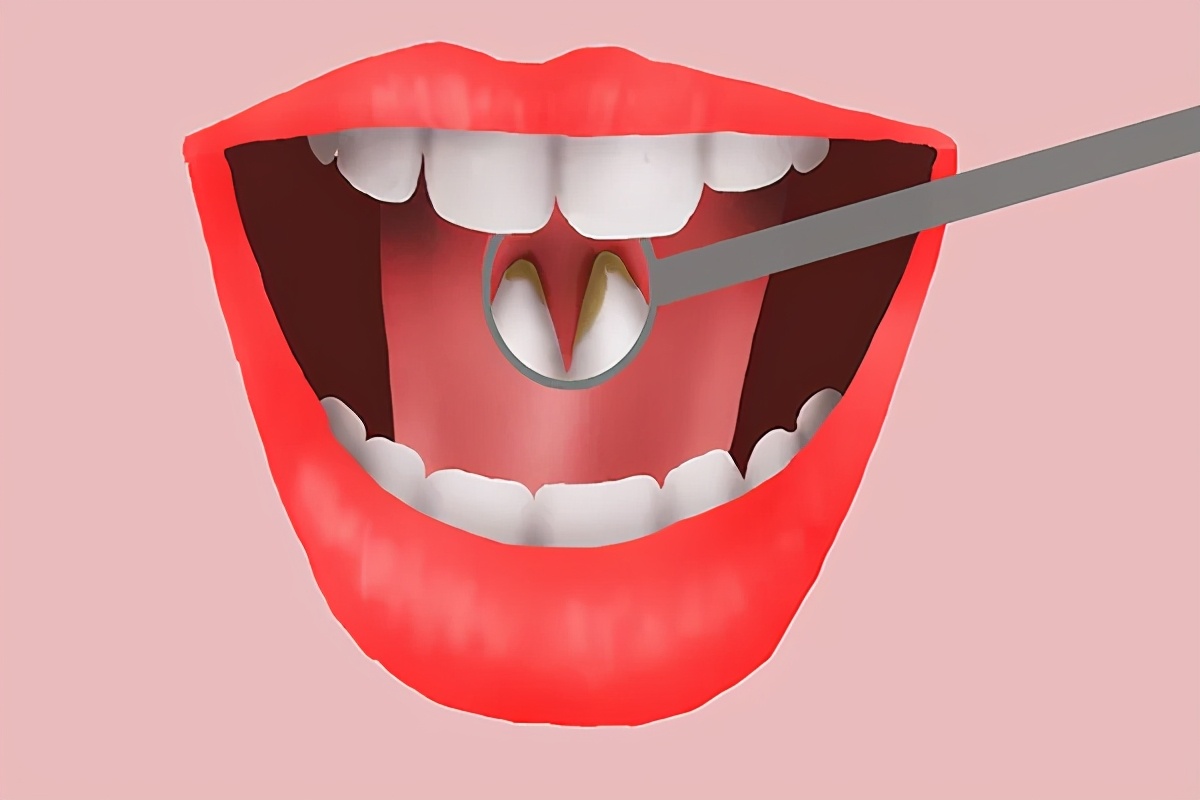 口臭是怎么回事如何解决口臭问题,口臭是什么原因用什么方法治口臭