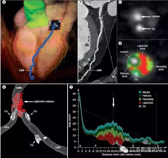 冠脉CT血管造影诊断高危斑块病变影像学特征分析