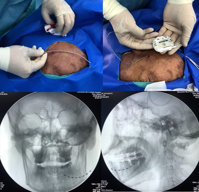 面部疱疹病毒症状,脸上疱疹病毒引起头刺痛