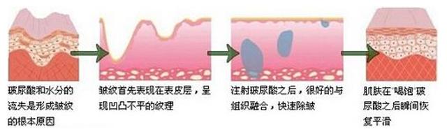 玻尿酸胶原蛋白的功效与作用,玻尿酸的功效医美