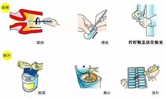 试管前期女性检查知多少——TCT检查