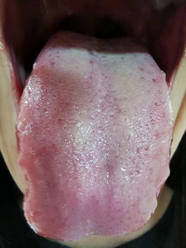 鼻咽炎与月经有关系吗,鼻咽炎鼻咽部一直有痰吞咽疼