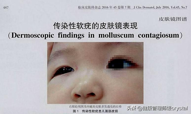 传染性软疣是湿疹吗,传染性软疣湿疹