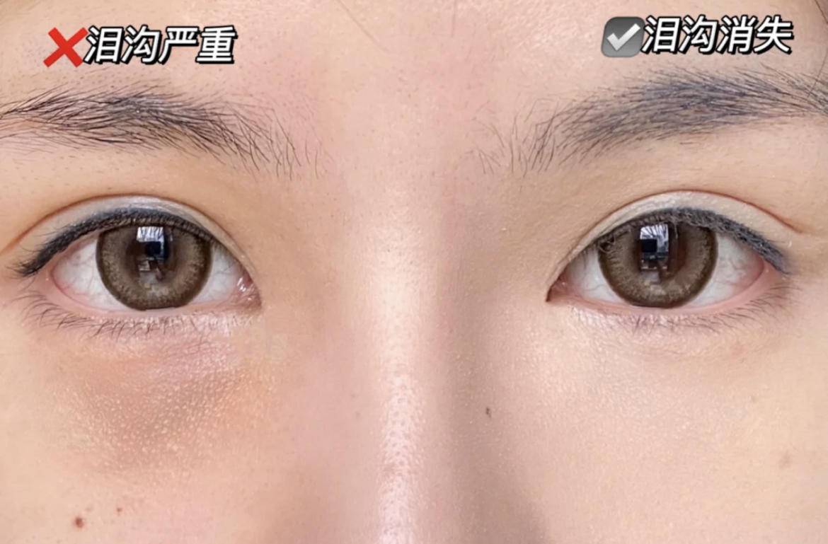 严重泪沟黑眼圈,淡化黑眼圈和泪沟原理