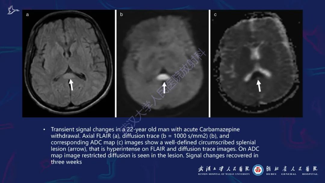 胼胝体肿瘤影像鉴别,胼胝体病变影像诊断