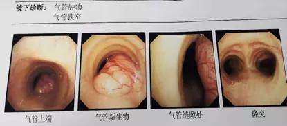 儿童90%为良性,成人却不到10%?患者气短3年,胸部CT提示的气管肿物意味着什么?气管镜有何发现?