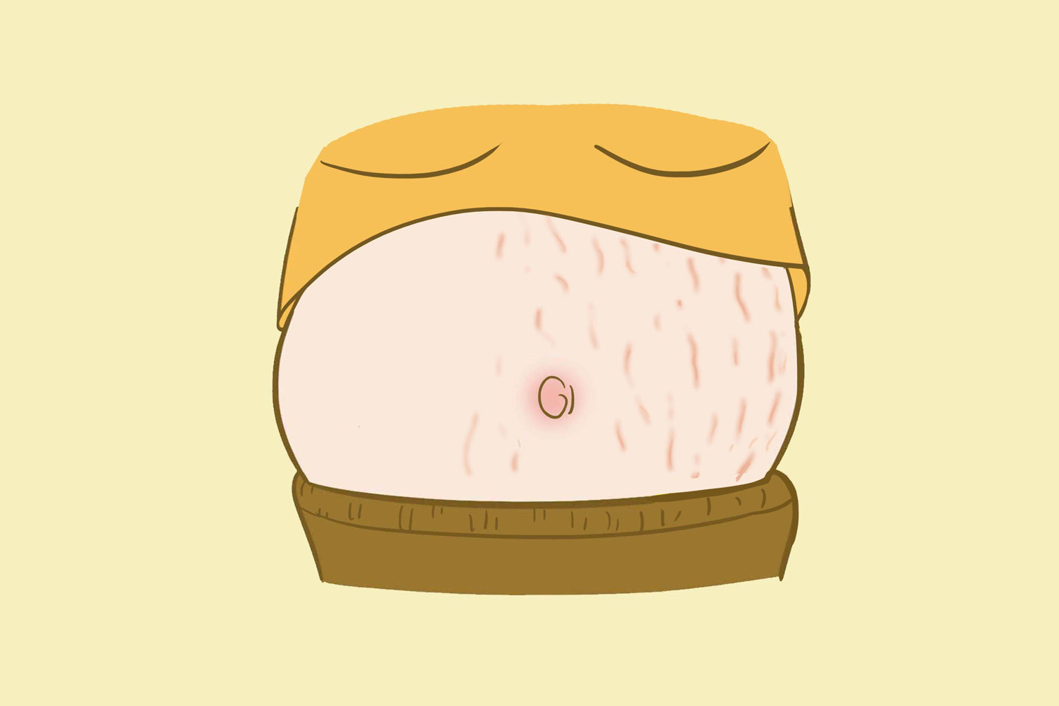 淡化产后妊娠纹最好的方法,产后好几年了妊娠纹怎么去除