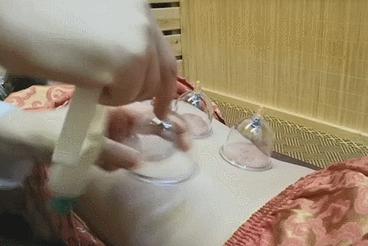 天津口碑好的中医推拿培训机构,天津拔罐