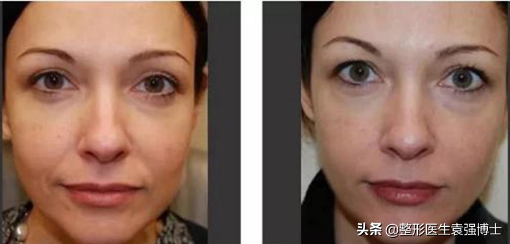 一招教你解决法令纹,这3种方法解决法令纹效果很惊艳