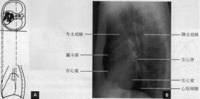 详细的胸部X线解剖，最基础最实用！