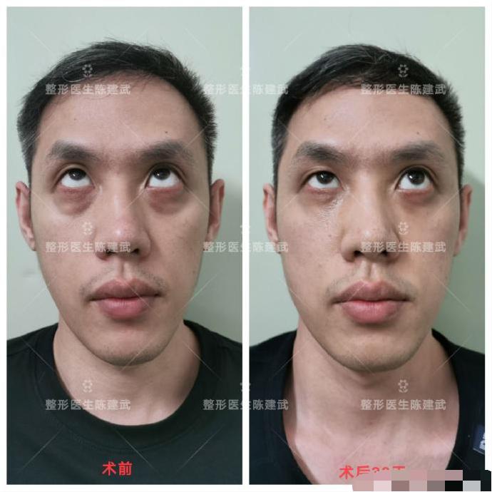 去眼袋泪沟医美方法,想了解一下去眼袋的最佳方法