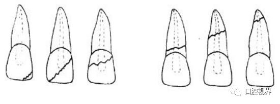 门牙折断牙根完好怎么办,门牙意外脱落怎么修复