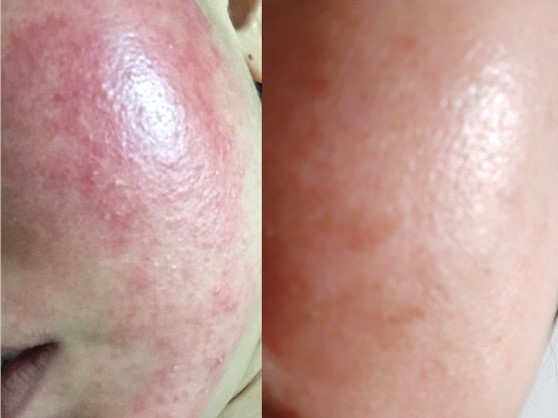 17岁女儿脸上长满痘痘，看了这篇文章才知道如何帮助她