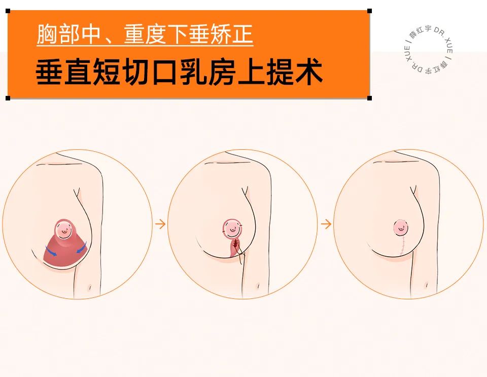 把胸往上提能治下垂吗,瑜伽可以使下垂的胸部上提吗