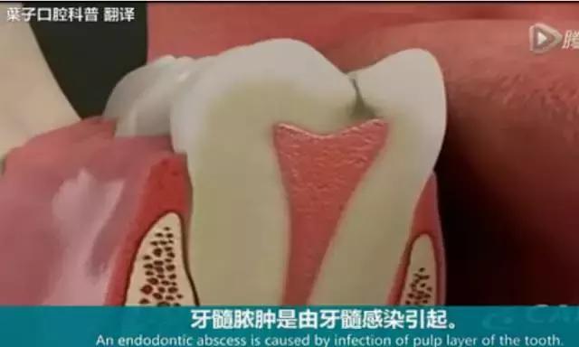 上牙龈上火突出一个鼓包,牙龈肿胀鼓包上火了吗