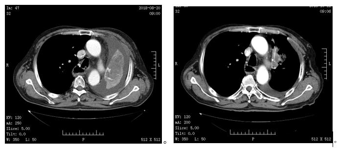 安罗替尼适合何种肺癌,柳暗花明好人一生平安