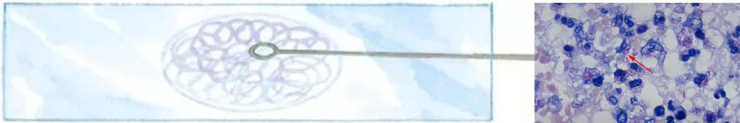 结核诊断方法和防治原则,结核的病原学诊断