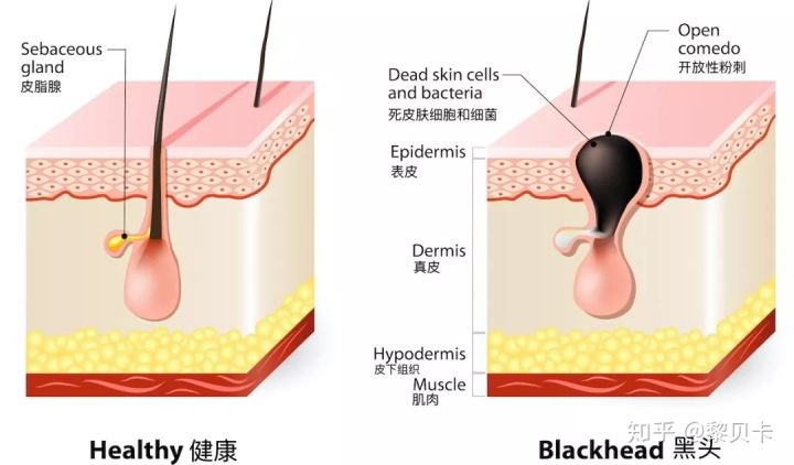 黑头去除神器排行榜,黑头粉刺清除强力推荐网红产品