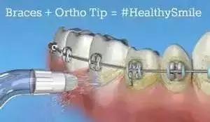 矫正牙齿是如何戴牙套的,矫正牙齿戴牙套需要注意事项