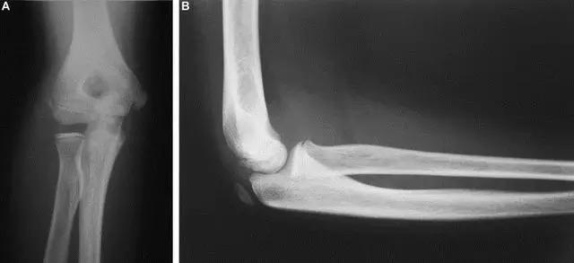 特殊骨折类型,特殊骨折体征