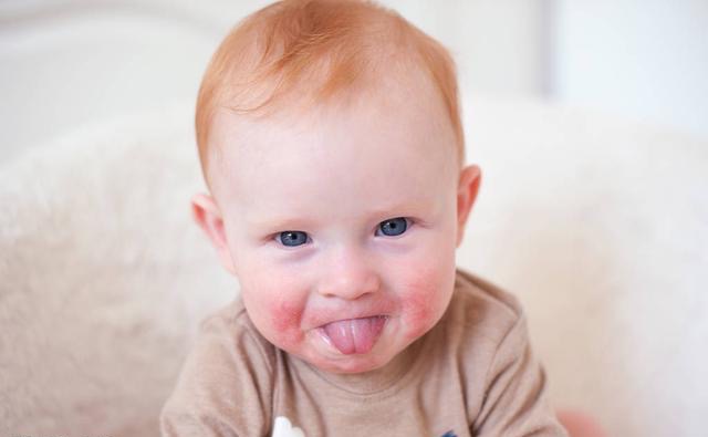 小孩吃芒果过敏去医院,小孩子芒果汁过敏是什么症状