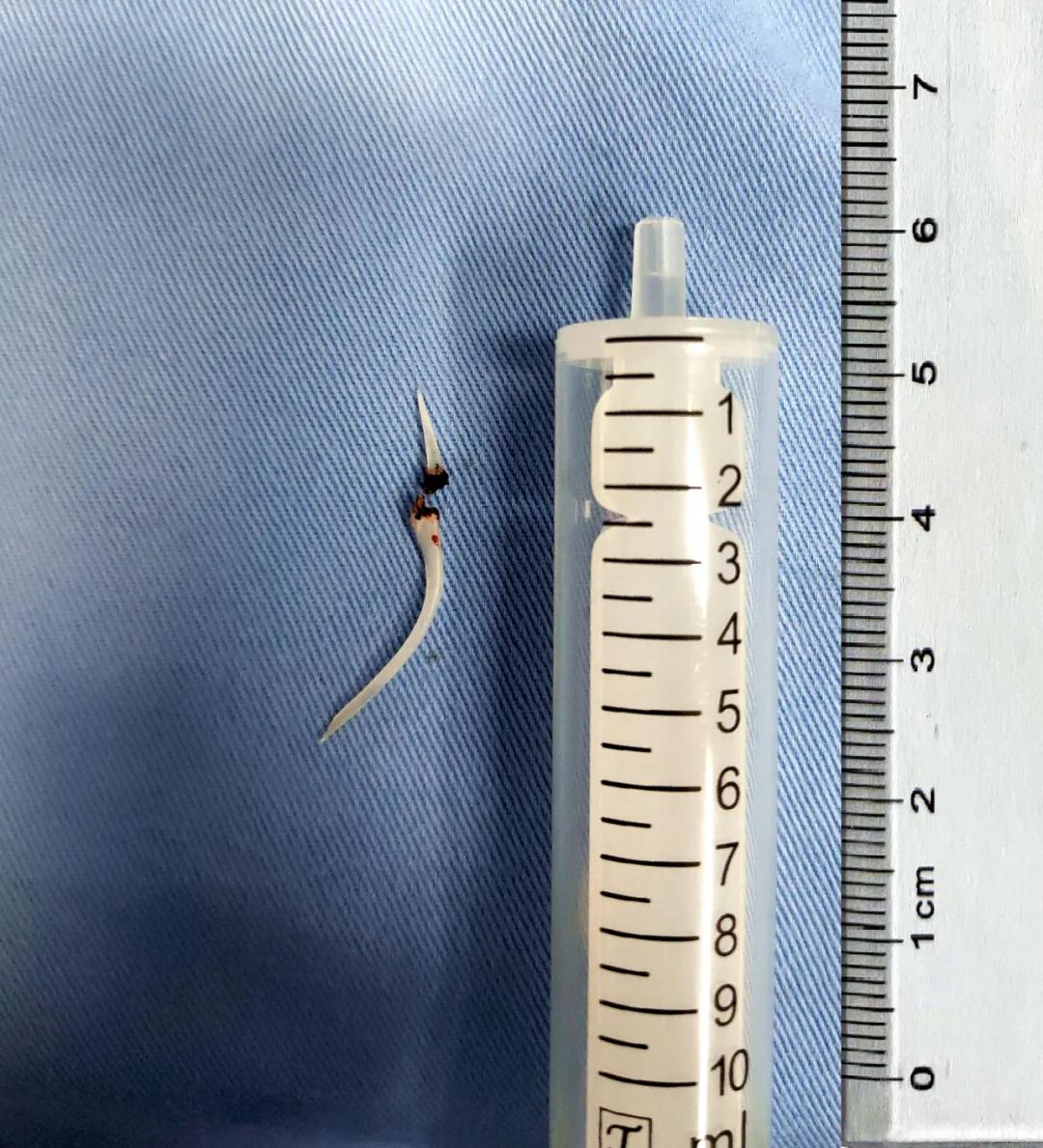 鱼刺卡住吞饭更严重示意图,鱼刺卡喉吃馒头咽下去了会怎样