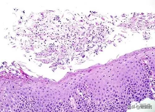 霉菌性食管炎的克星,霉菌性食管炎吃哪种中成药
