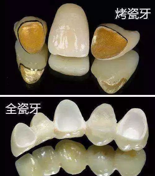 根管治疗后要戴个牙冠，是医生忽悠你吗？