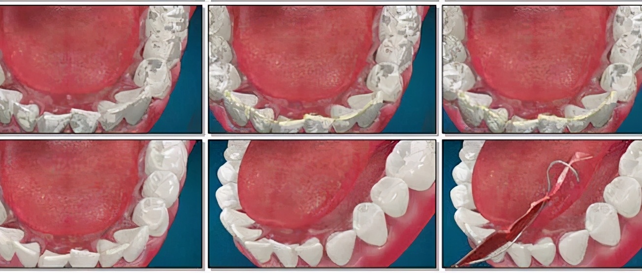 矫正牙多久能戴上牙套,矫正牙需要戴牙套一辈子吗