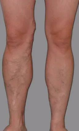 年轻女孩腿部静脉曲张,有年轻的女性得静脉曲张吗