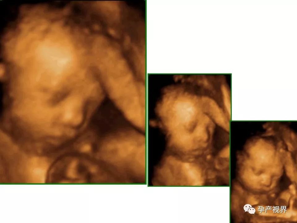 刚怀孕50天做b超能检查出来什么,怀孕初期检查hcg翻倍需要查几次