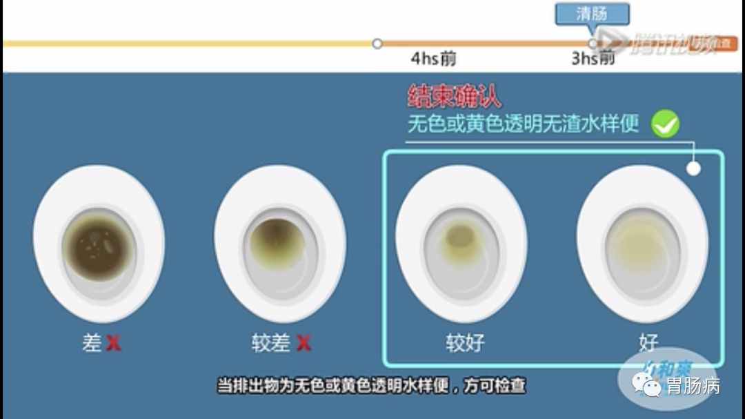我做普通肠镜的经历及感受,年轻人做普通肠镜可以忍受吗