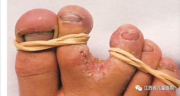 3岁小孩得脚气痒怎么缓解,小孩脚气痒痒难忍怎么办