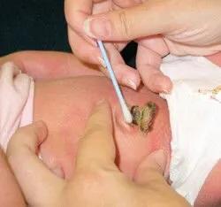 关于宝宝健康的知识,宝宝出生第一天脐带怎么护理