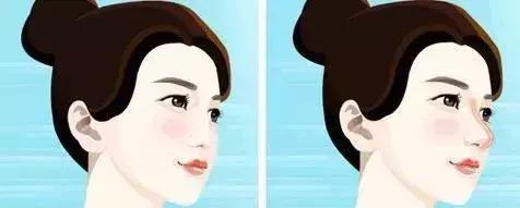 隆鼻的最佳方案,注射隆鼻的四大功效