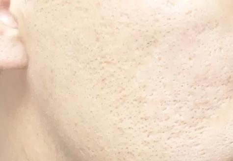 毛孔粗大推荐产品,最好用的收缩毛孔的产品