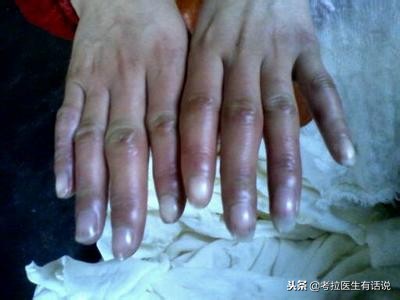 冬天手脚冰凉生冻疮治疗偏方,冻疮红肿瘙痒可以用红霉素药膏吗