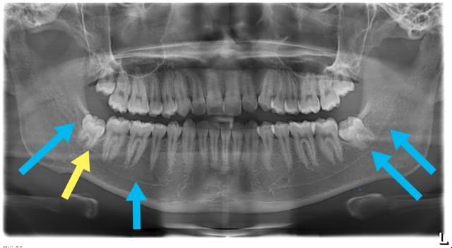 智齿老是发炎到底要不要拔掉,智齿总是发炎为什么牙医建议不拔